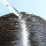Eliminar la caspa en un día: remedios naturales que funcionan