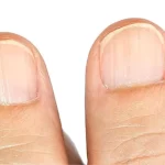 Uñas con rayas y líneas: conoce sus causas y significados